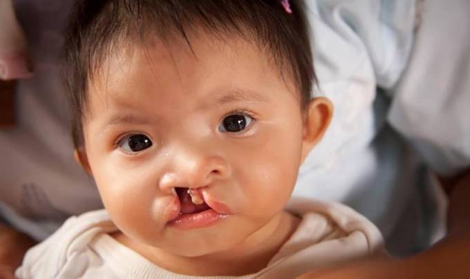 Why Babies Need Palate Repair Surgery?