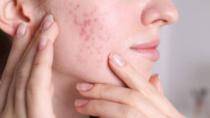 How Acne Treatment Works Within the Skin Layers?