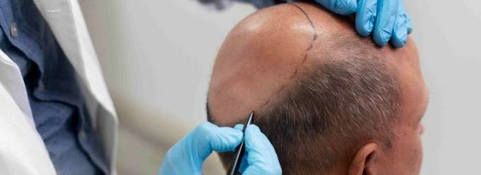What Best Hair Transplant Involves in Core Assessment Steps?