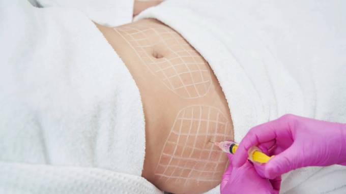 What should I know before aqualyx injection treatment?