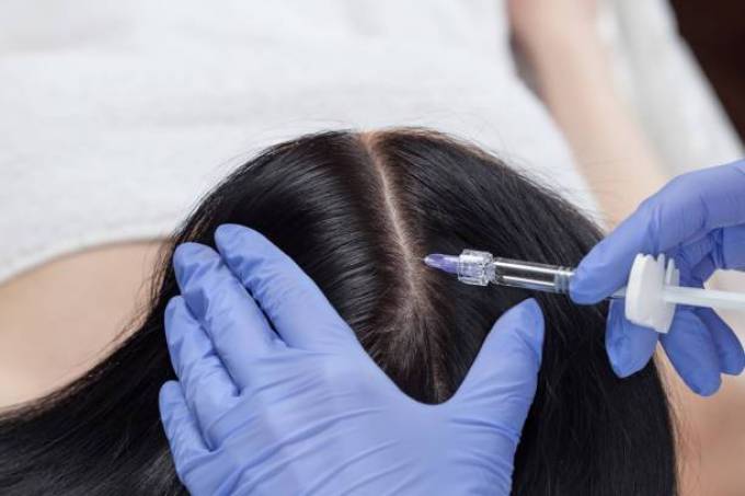 How Effective Is Hair Plasma Treatment Today?