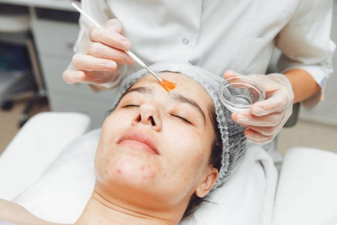 Can You Do a Chemical Peel Safely at Home?