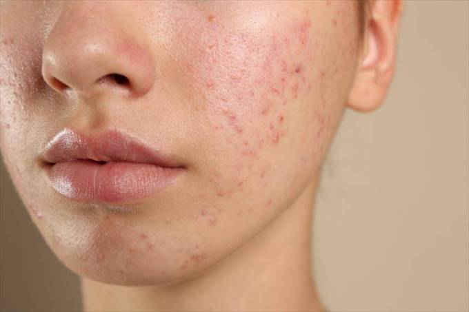 How Is Skin Assessed for Acne Scar Treatments?