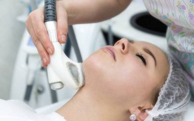What is the role of laser skin resurfacing in acne scarring?