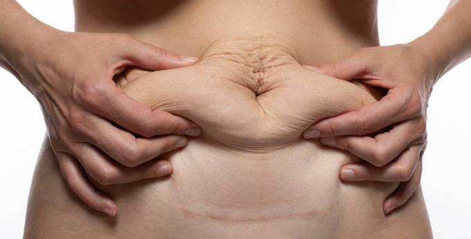 Does Tummy Tuck Treatment Affect Muscles?