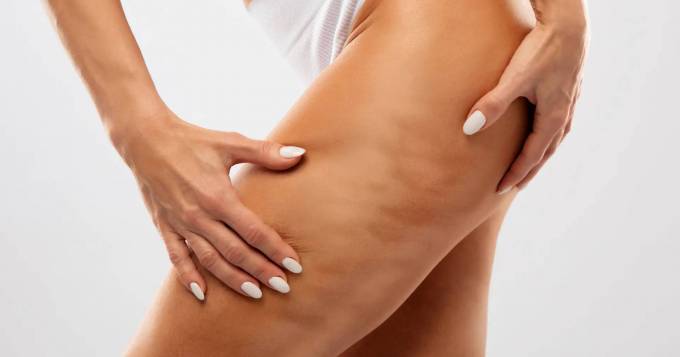 Is cellulite treatment cost affected by skin type?