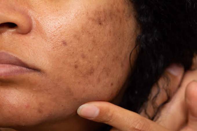 Scientific Facts About Best Pigmentation Treatment