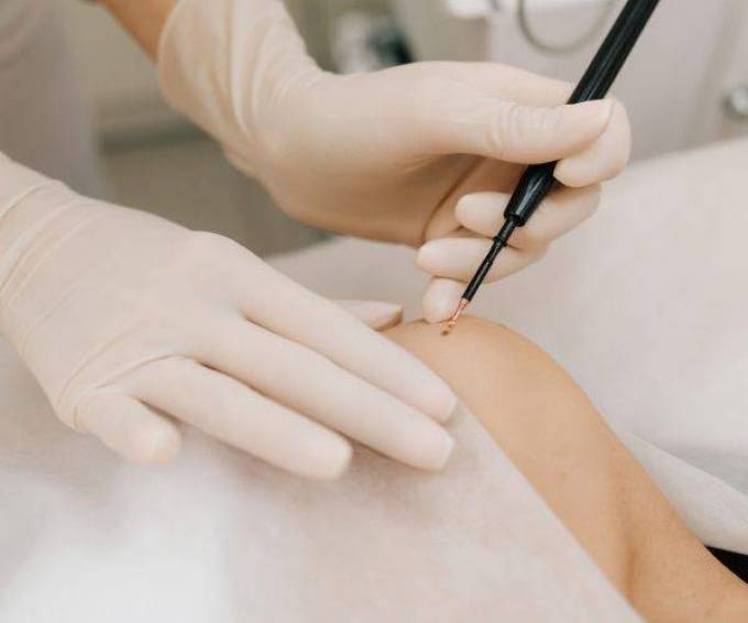 Is Mole removal Suitable for Various Skin Concerns?
