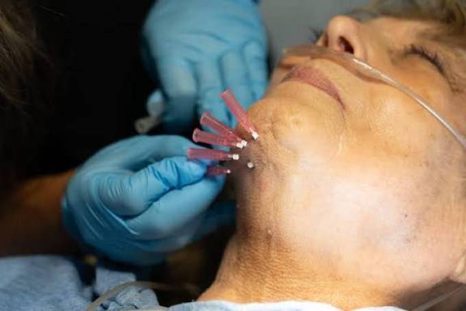 What Is the True Cost of a Thread Lift?